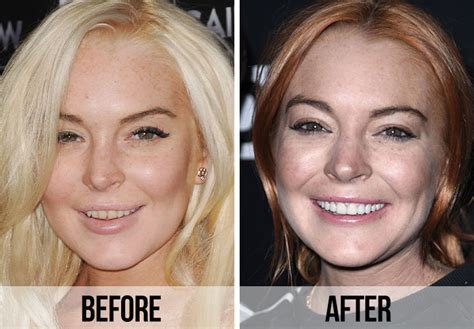are lindsay lohan's teeth fake